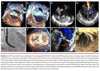 Preprocedural transesophageal echocardiography