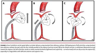 Gore Cardioform atrial septal defect occluder delivery