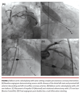 Balloon aortic valvuloplasty with same-setting complex percutaneous coronary intervention.