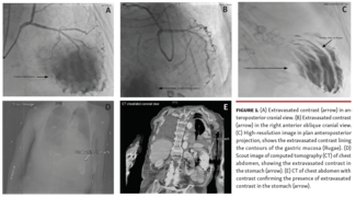  Extravasated contrast (arrow) in anteroposterior cranial view