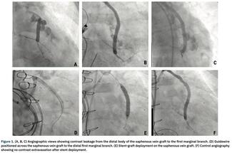Pellegrini Saphenous Vein thumbnail