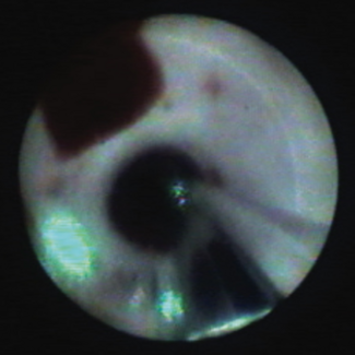 Djelmami-Hani - HeartLight X3 Endoscopic Ablation System