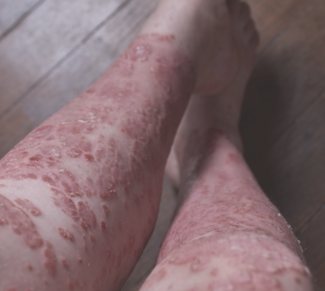 psoriasis
