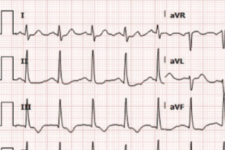 Prousi - Ventricular Tachycardia