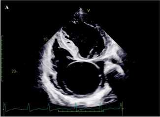 Figure 1. (C, D) Contrast-enhanced computed tomography confirmed aneurysmal dilation of the aortic root and proximal part of the ascending aorta. (E) 3D reconstructed computed tomography image.