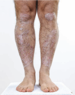 psoriasis on the legs