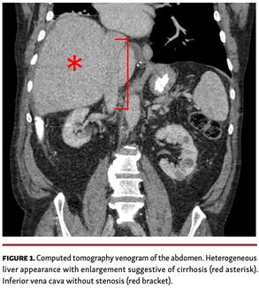Computed tomography venogram of the abdomen.