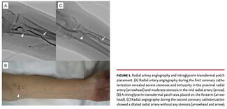 Radial artery angiography and nitroglycerin transdermal patch placement.
