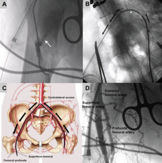 FIGURE 2. (A) Right femoral arteriogram showing the arteriovenous fistula (arrow). (B, C) Contralateral advance of the Fluency stent (asterisk). (D) Final result.