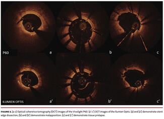 Figure 3. Optical coherence tomography