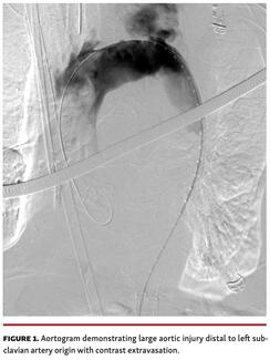Aortogram demonstrating large aortic injury distal to left subclavian artery origin with contrast extravasation.