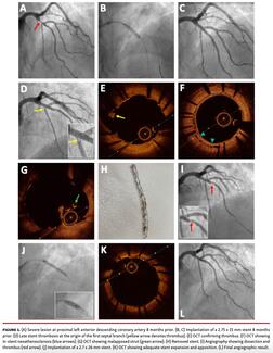 Severe lesion at proximal left anterior descending coronary artery 8 months prior