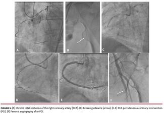 Chronic total occlusion of the right coronary artery