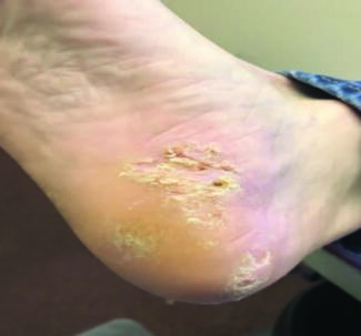 When A Patient Presents With Chronic, Non-Resolving Pedal Plaques