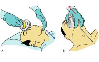 Figure 1: Chin lift grip (Image: Adrian Matioc, MD) 