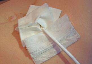 A ventricular assist device (VAD) is a manmade electromechanical pump implanted in either the right or left ventricle (or both) that assists the heart in circulating blood. 