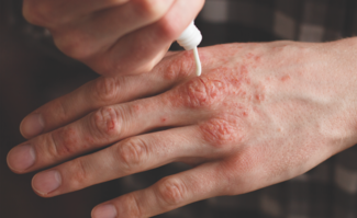 Hand eczema strategies
