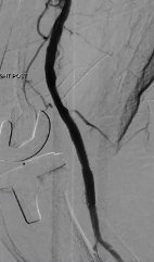 Mustapha CLI Antegrade Femoral