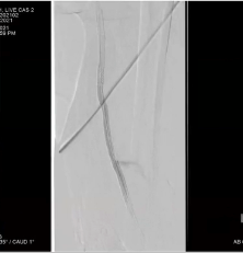 Mustapha CTO Crossing Retrograde Pedal Access