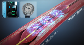 Shockwave IVL Mechanism of Use