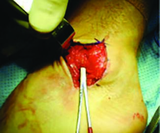 Photo courtesy of Bradly Bussewitz, DPM and Christopher Hyer, DPM FACFAS