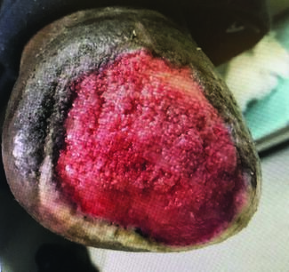 Crucial Considerations In Diabetic Foot Ulceration And Nutrition