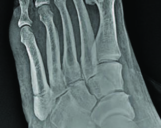 Fifth Metatarsal Fractures In The Athlete