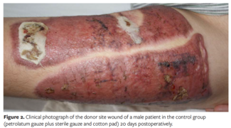 Silver Ion Hydrocolloid Gauze and Self-Adhesive Polyurethane Foam Dressing Combination Therapy Can Better Promote Healing of Skin Graft Donor Area Than Traditional Therapy: A Case Control Study