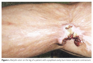 Marjolin ulcer on the leg of a patient with a popliteal cavity burn lesion and joint contracture