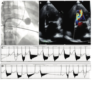Long Valvuloplasty Figure 2