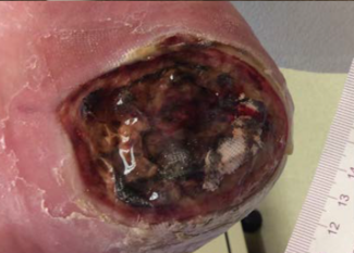 Necroslough after sharp debridement of a pressure injury and application of collagenase