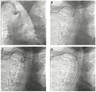 Sayfo STEMI Figure 3