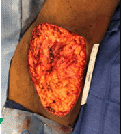 Hidradenitis Suppurative