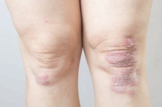 Red scaly psoriasis on White skin kneecap