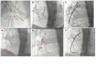 Shah vasospasm Figure 1