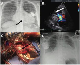 Figure 1 - Garner - Tricuspid Regurgitation