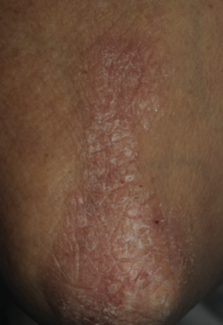 Psoriasis on an elbow with the potential link to psoriatic arthritis showcasing the possibilities of psoriatic treatment. 