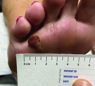 When A 65-Year-Old Female Presents With A Painful Protruding Forefoot Lesion