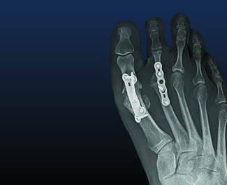 Surgical Options For Second MPJ DJD