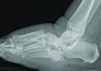 Is An Acute Charcot Event A Similar Process To A Cytokine Storm?