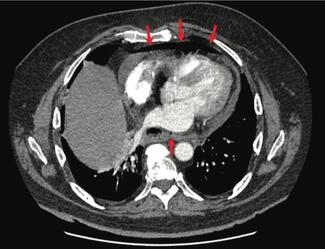 Catanzaro Catheter Ablation thumbnail