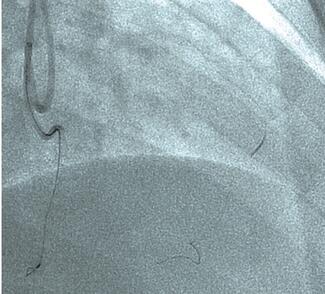 Chahal retrograde thumbnail