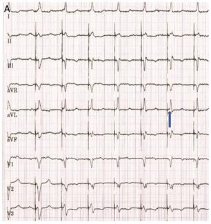 Ezzeddine-Dandamudi Conduction System Pacing thumbnail