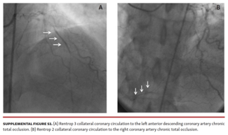 Endothelial Progenitor Cell Function in Coronary CTO Patients