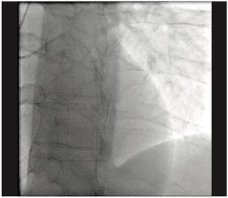 ImagingCorner stenting thumbnail