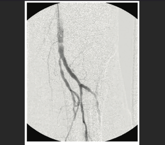 Nair CART technique thumbnail