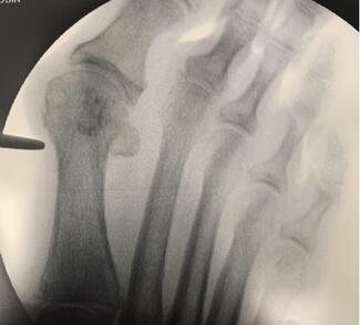 Getting Started With MIS Bunion Surgery