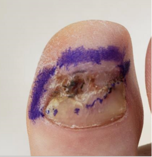 Cases Of Rare Pedal Melanomas