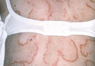 subacute cutaneous lupus erythematosus 