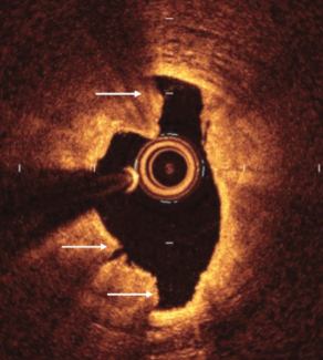 Shlofmitz CLD IVL OCT image